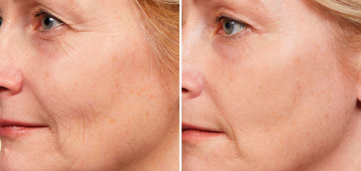 El Sérum Noche Retinol Puro de la gama Revitalift Laser de L’Oréal Paris no es la solución para saber cómo eliminar tus arrugas profundas por completo, pero sí para rellenarlas y alisarlas.